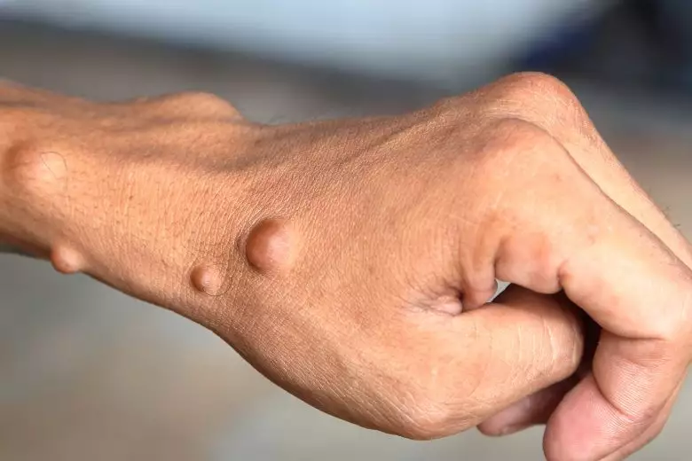 Experten & Kliniken für Neurofibromatose